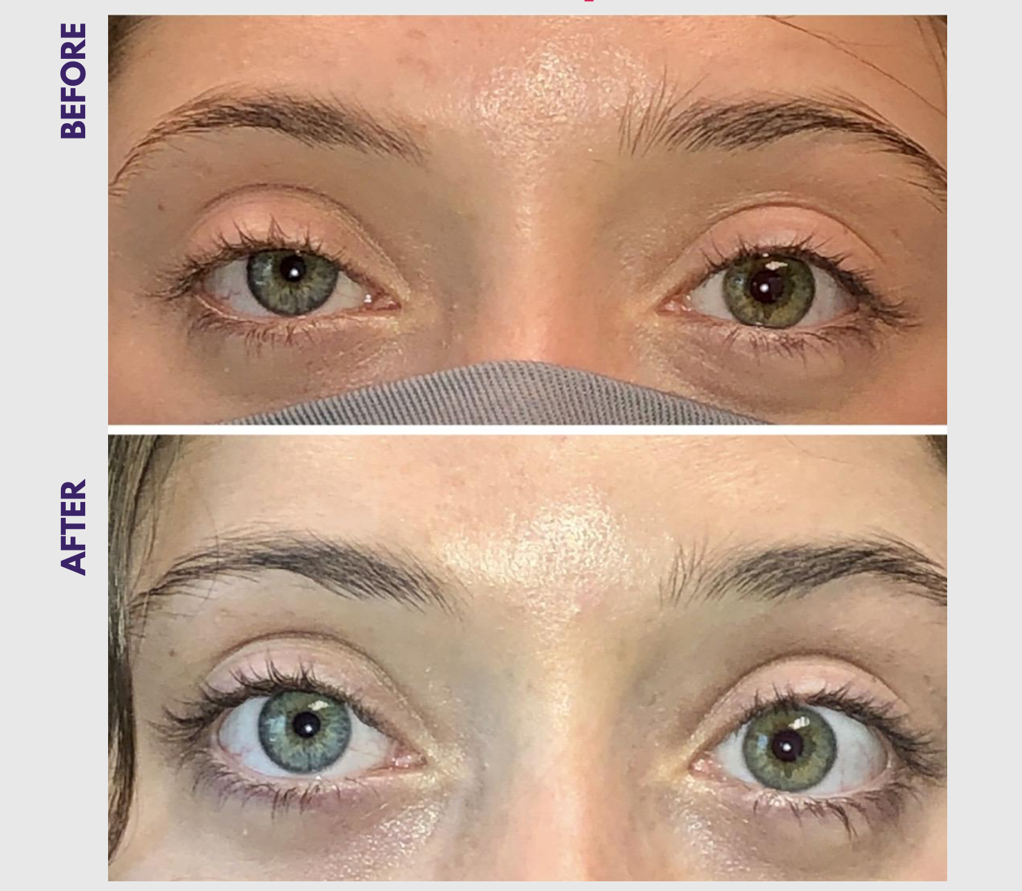 Ptosis repair eyelid surgery