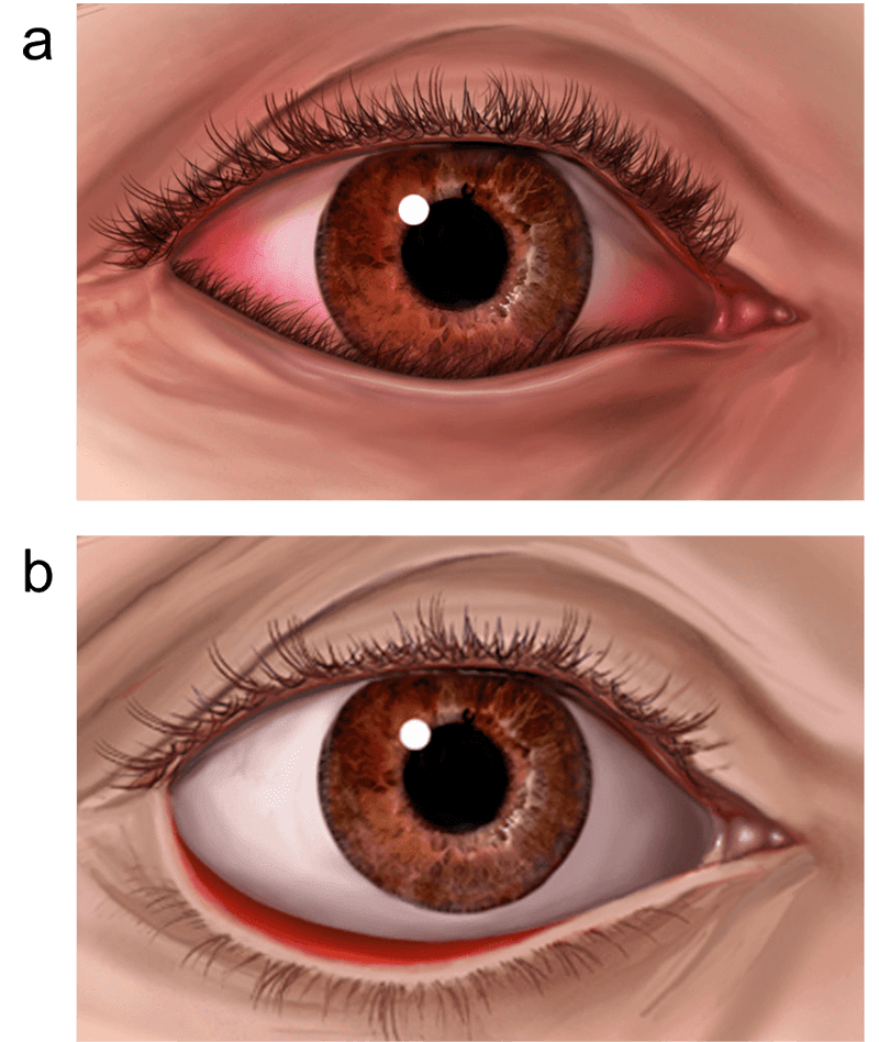 a Entropion - eyelid turned in 
b Ectropion - eyelid turned out