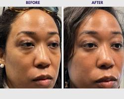 Blepharoplasty surgery